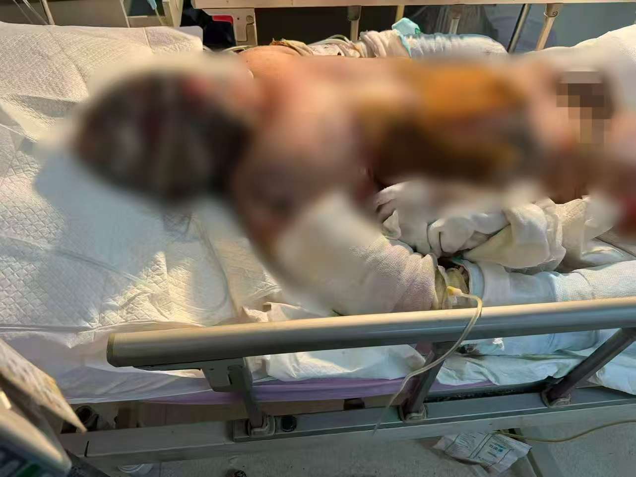 父子在哈尔滨一亲戚公司上班遇爆炸全身烧伤<strong></p>
<p>方正科技股票</strong>，治疗花费近百万公司拒赔偿？亲戚回应