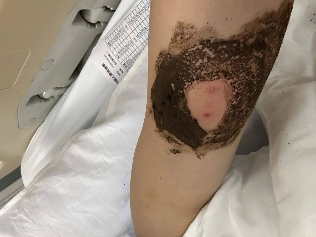 4名游客景区内遭马蜂袭击<strong></p>
<p>方正科技股票</strong>,旅游度假区:是森林公园不卖门票,蜇伤先就医后提供证据投诉