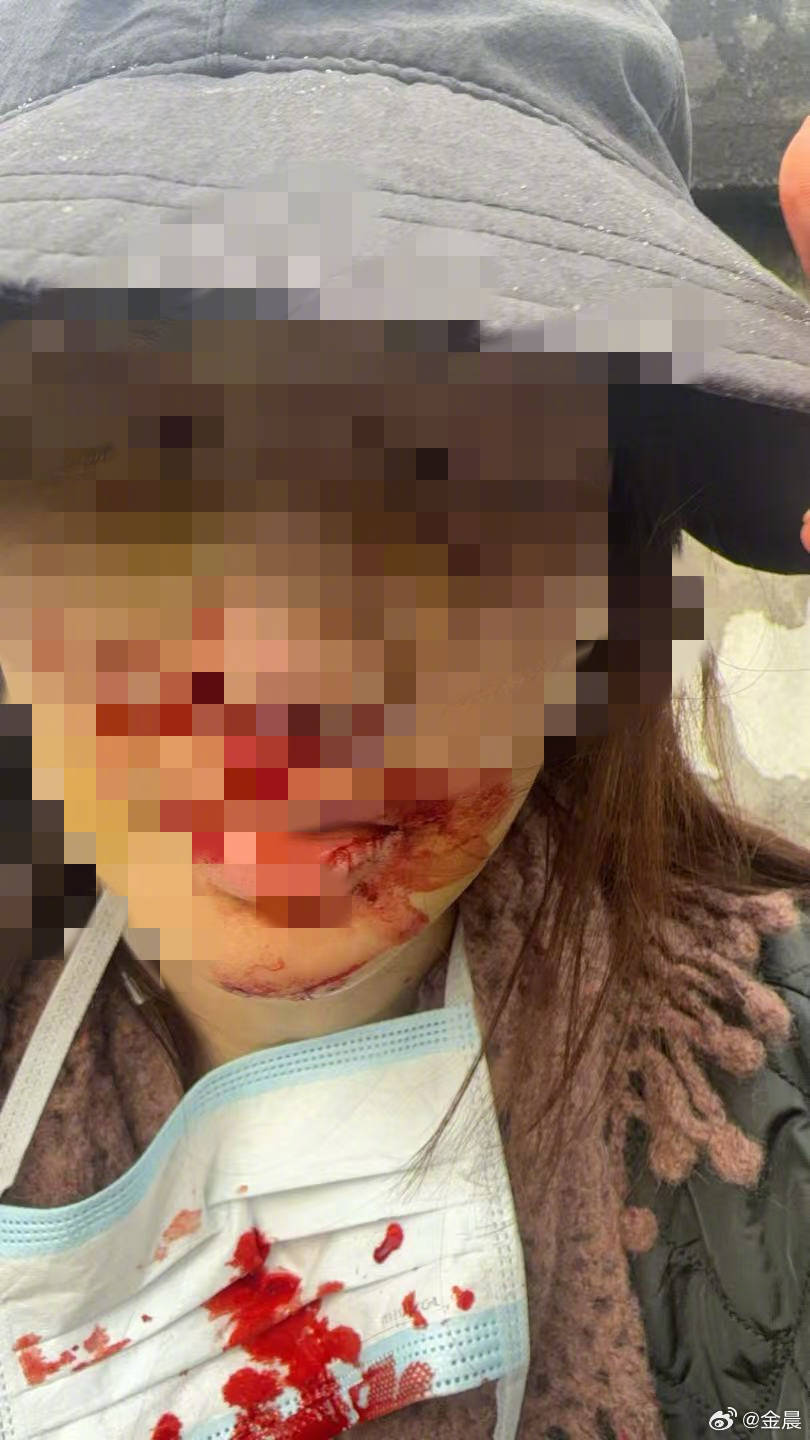 警方发布警情通报后<strong></p>
<p>太平洋股票</strong>，金晨晒脸部受伤照片并发文道歉